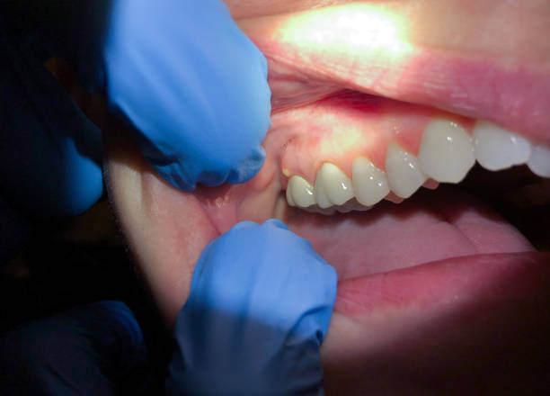 Best Urgent Dental Care for Toothache in Bismarck, MO